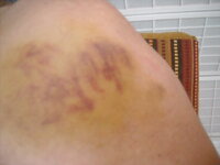 45-70 bruise.JPG
